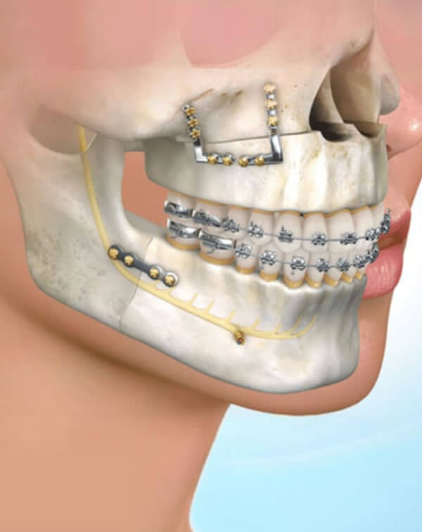 Maxillofacial Surgery